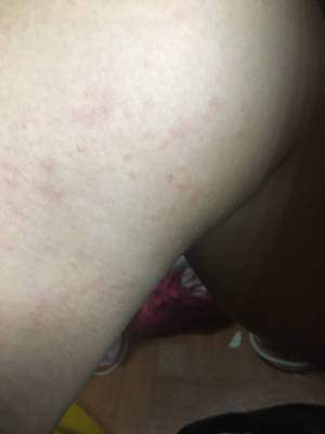 大腿内两侧一点点红色的,好痒,是寻麻疹吗?能
