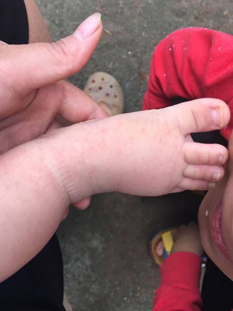 宝宝五个月手上和脚上起了好多小水泡似的?_