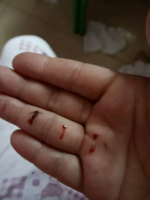 死蚊子,打死你_毁容了