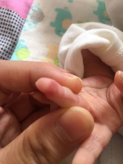 宝宝半个月 一个手指指肚突然变红 是血管瘤吗