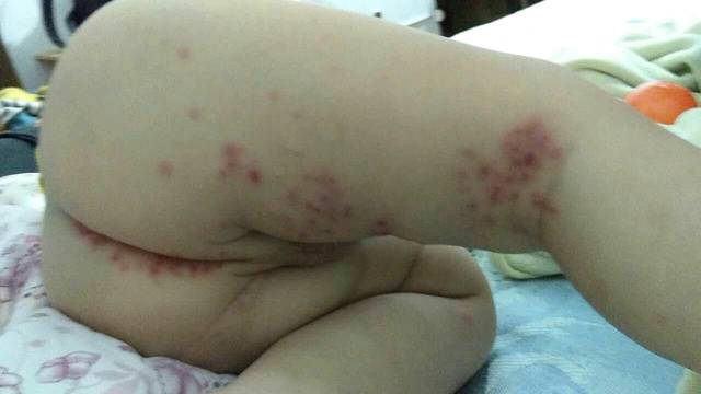 15个月男宝出现严重手足口病怎么办_头一天晚