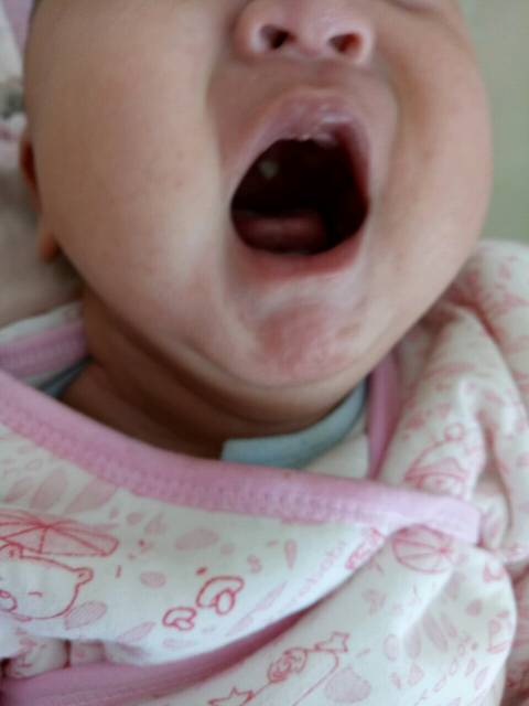 这是什么,求知道的宝妈告知_孩子上颚上白色的