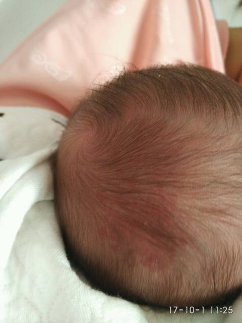 头上的是胎记吗?_我看网上说宝宝容易有血管