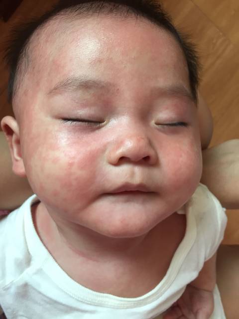 疹_宝宝5个月第一次生病就是幼儿急疹,这样毫无