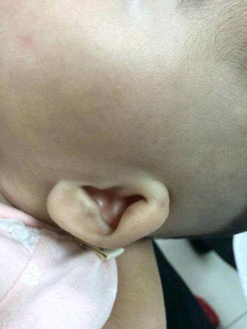 宝宝耳朵畸形?_耳廓形态畸形的类型? 耳廓形态