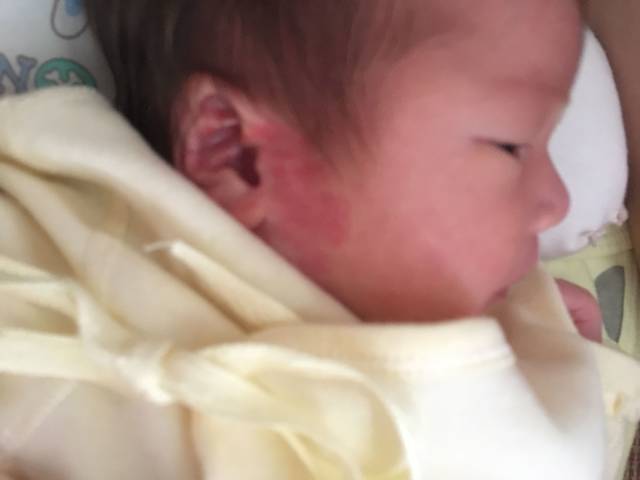 刚刚出生十天的的宝宝,耳朵旁边的皮肤有一片