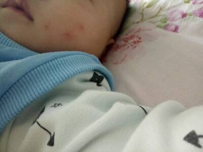 宝宝脸上被蚊子咬了之后自己又把抓破了,这都
