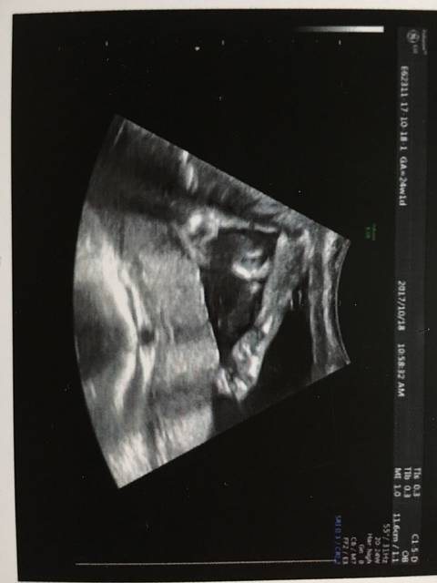 24周排畸b超在此,谁能给看看男女?_二胎,所以