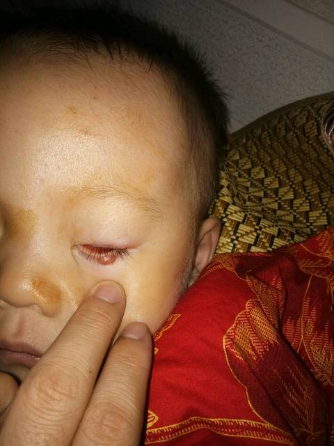 宝宝眼睛上得了麦粒肿怎么办_宝宝快两周了眼