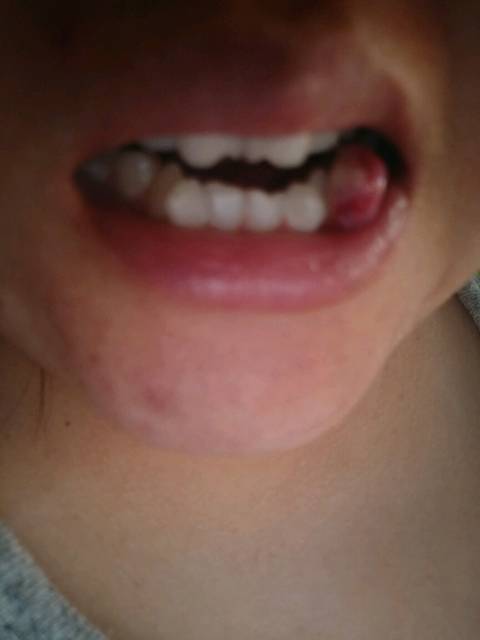 有没有姐妹也长了妊娠牙龈瘤啊我的图片很吓人