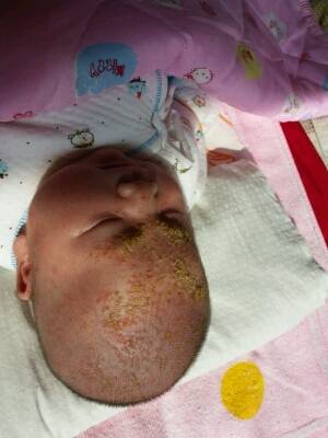 宝宝出生26天,出生第12天脸上出现米粒大小红