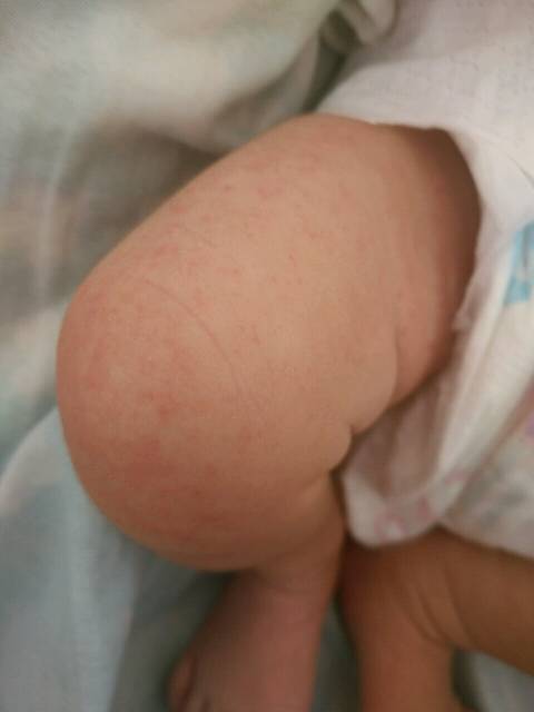 _宝宝身上和脚上都起这个小红点点 有经验的宝