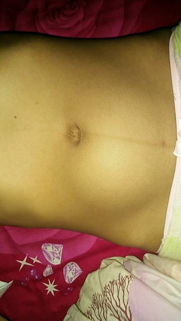 15周的肚子_每天早晨肚子都有一块鼓鼓的,硬硬