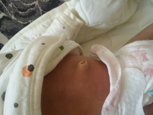 18天的孩子,肚脐眼突出是怎么回事?