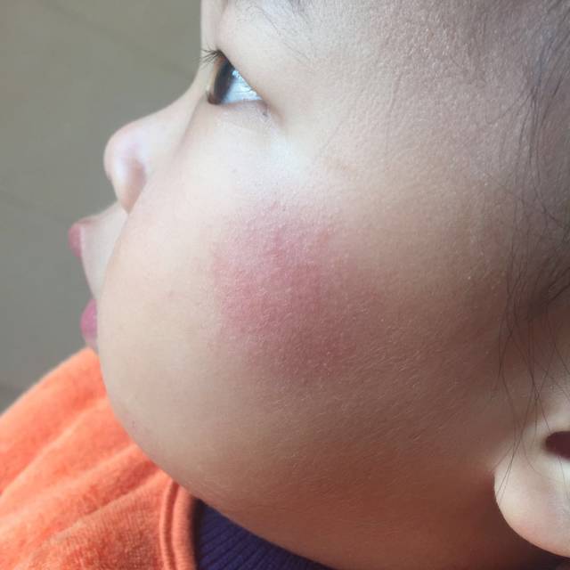 宝宝脸上疹子_这是什么湿疹么?