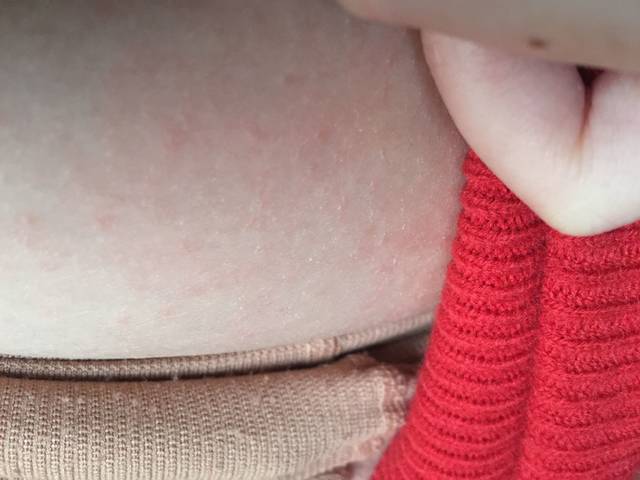 孕五个多月肚皮上面有红色小疹子是什么原因?