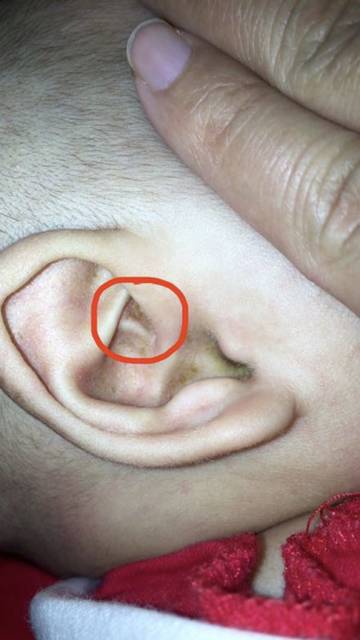 宝宝耳朵发现有一个软骨一样的东西_宝宝出生