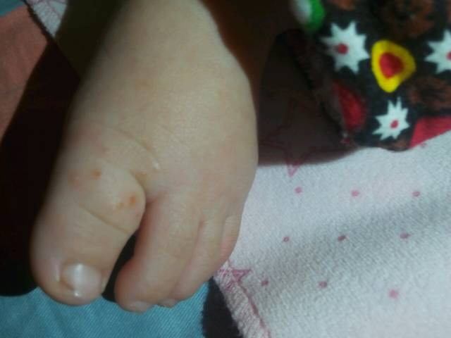 这是湿疹还是疱疹?_宝宝脚上长了水泡样的小