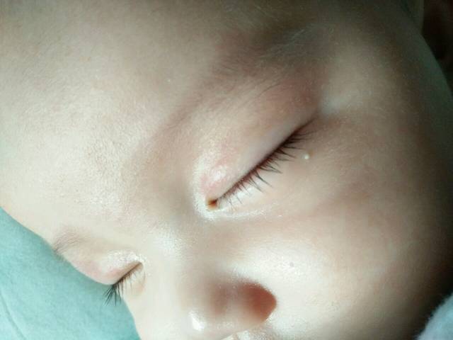 宝宝右下眼皮长了个白色颗粒 像脂肪粒