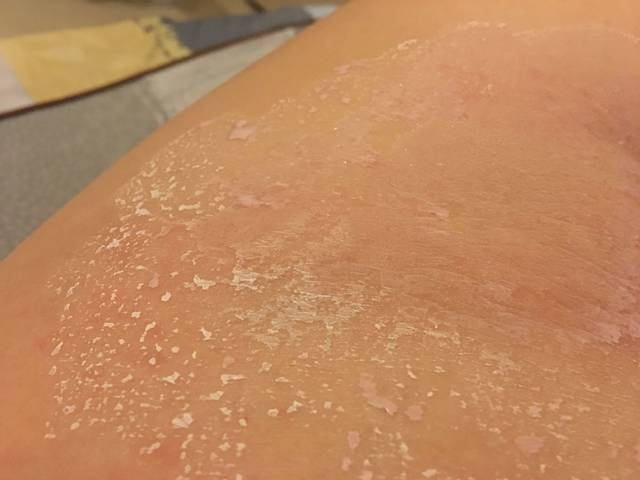 痒痒痒,超级痒_怀孕以来腿的左侧经常超级痒,