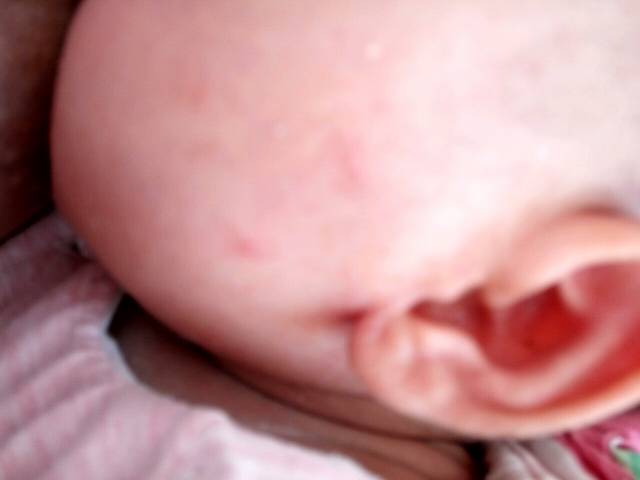 宝宝脸上涨了疙瘩,是湿疹还是痱子啊?宝宝脸上