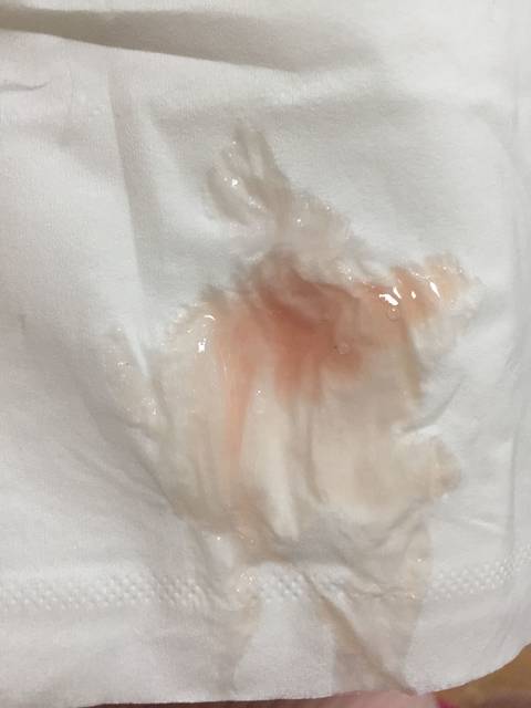 粉色还是褐色分泌物?!亲们,帮我看看_早上起来