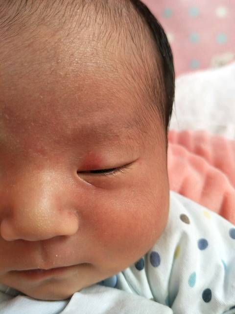 新生儿红斑_从一出生宝宝脑门上眼皮上就有一