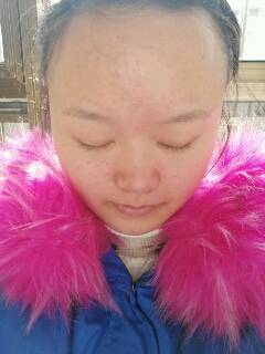 有没有跟我一样的额头脸上鼻子都是红痘痘,我