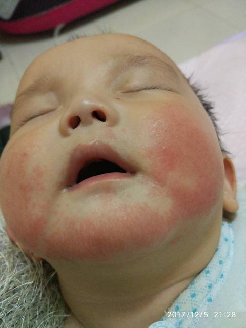 宝宝六个月脸上湿疹严重,哪位宝妈有经验教教