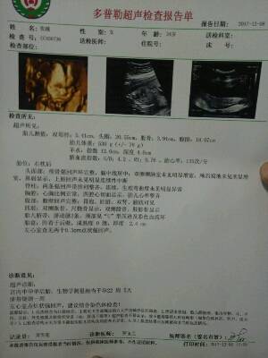 25周四维,医生说胎儿偏小两周!然后左心室有强