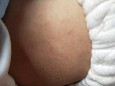 [当时年龄:宝宝6个月]宝宝前天半夜发烧39度,白