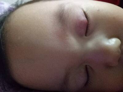 [当时年龄:宝宝1岁5个月]宝宝眼皮上长了小疙瘩