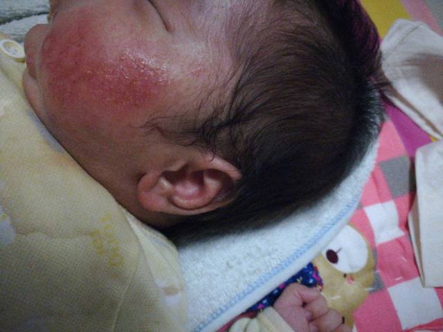 求助,40天宝宝得热疹怎么护理?