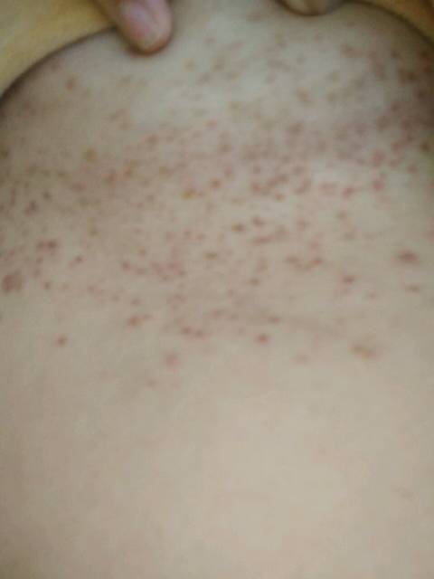 孕晚期长疹子了,真是苦不堪言,每天都是煎熬