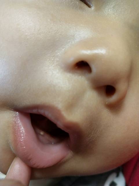 宝宝四个半月,下牙龈出个白点,硬硬的,是要出牙