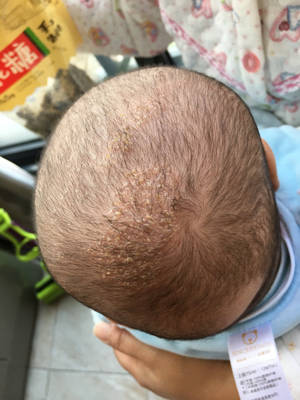 宝宝五个月了,头上长湿疹,几乎满头都是一个一