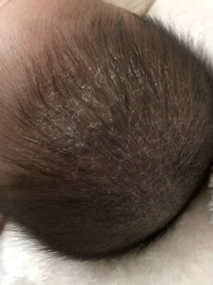宝宝四个多月了,头上总是有一层薄薄的皮,还很