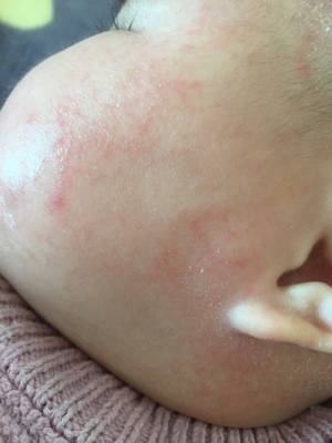 五个月宝宝脸上起皮红色的一片一片,是湿疹吗