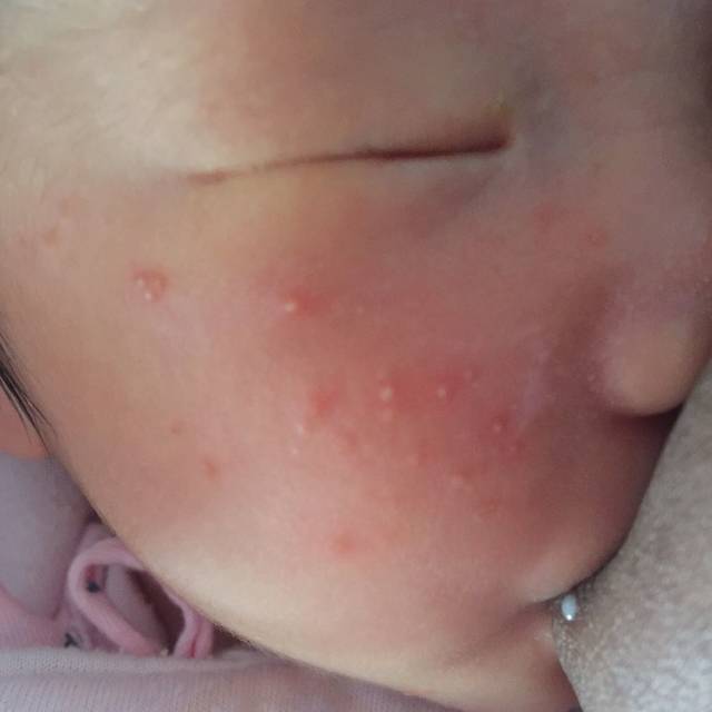 宝宝半个月了,脸上很多红疙瘩