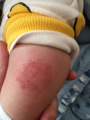 宝宝腿上长了一块红疙瘩,有时候就干的起皮。
