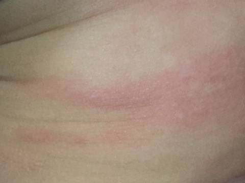 小孩15个月,今天下午突然手膀子上起红疹,很痒