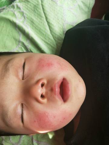 宝宝已经毛四岁了,脸上热了或者是吃东西蹭到