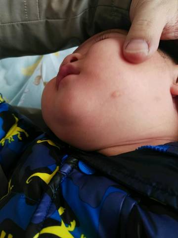 宝宝六个月,大概三个月时脸上被蚊子咬了几个