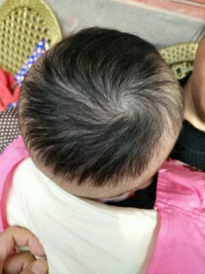 请问宝宝只有头顶长头发 ,很黑 ,只长头顶一圈是