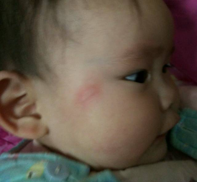 宝宝偶尔出扁皮疙瘩,不像是蚊子咬的
