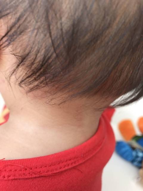 脖子后面长皮癣