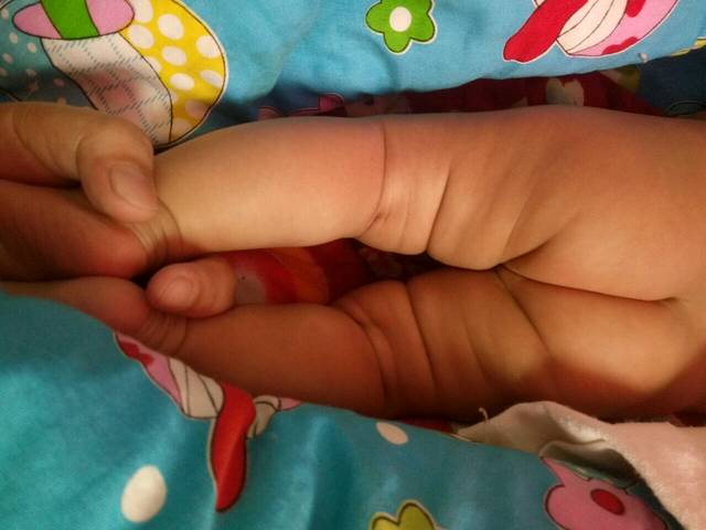 孩子腿纹对称吗