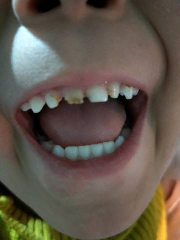 宝宝的第一颗牙齿是门牙,刚长出来就是有一个