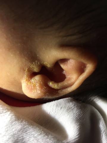 我家宝宝50天,今天发现耳朵上有脓水,耳朵一圈