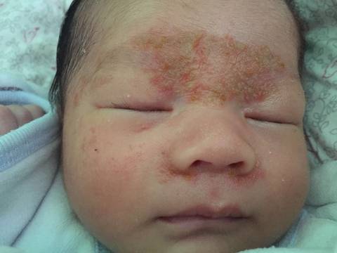 男宝宝22天,额头眉间长了一堆类似湿疹的红点